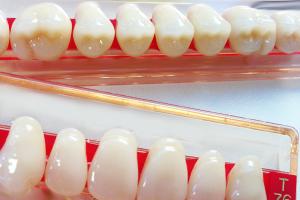 Разнообразие несъемных зубных протезов: от коронок до виниров