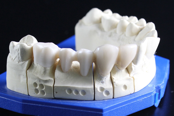 Герметизация зубов: ключевой момент сохранения зубной эмали